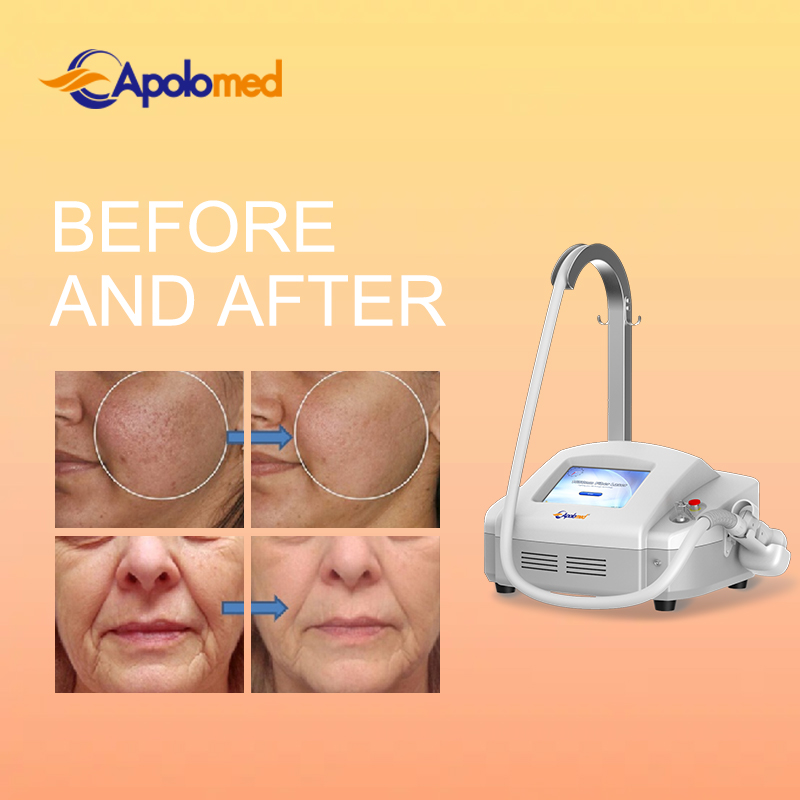 1550nm fiber laser: ushering in a new era of non-invasive skin care