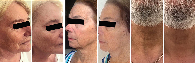 HS-510 before and after