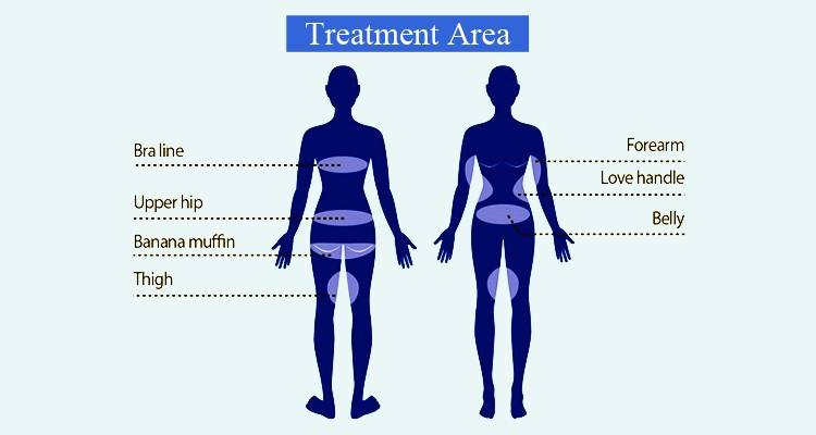TREATMENT AREA OF CRYOLIPOLYSIS