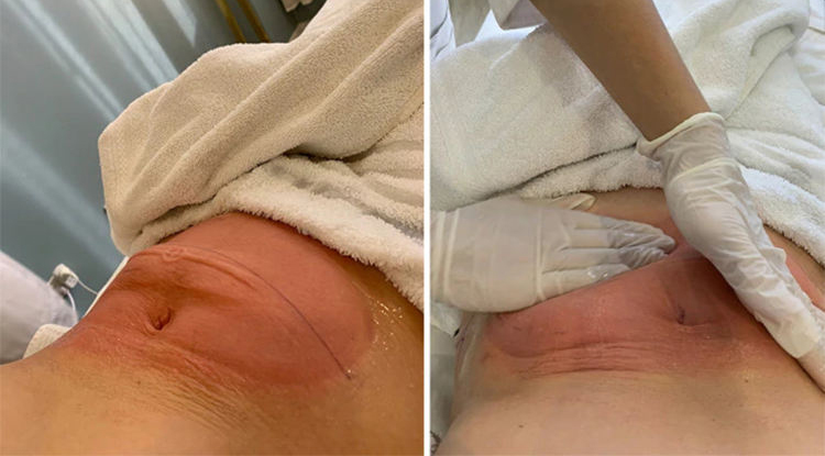 cryolipolysis treatment post care
