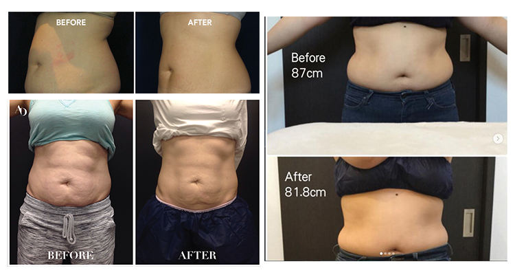 fat-freeze-cryolipolysis