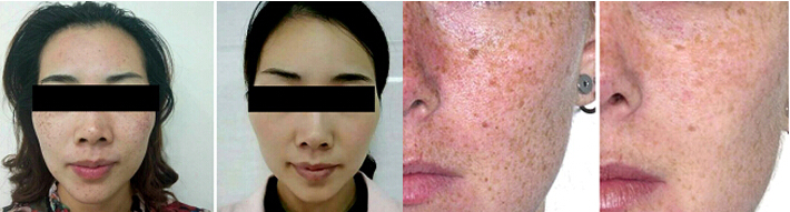 picosecond laser-9