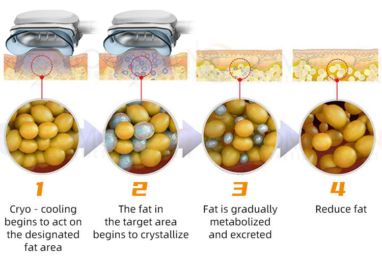 work theory of cryolipolysis